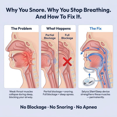 Selyca SilentSleep - Eliminates Snoring & Sleep Apnea